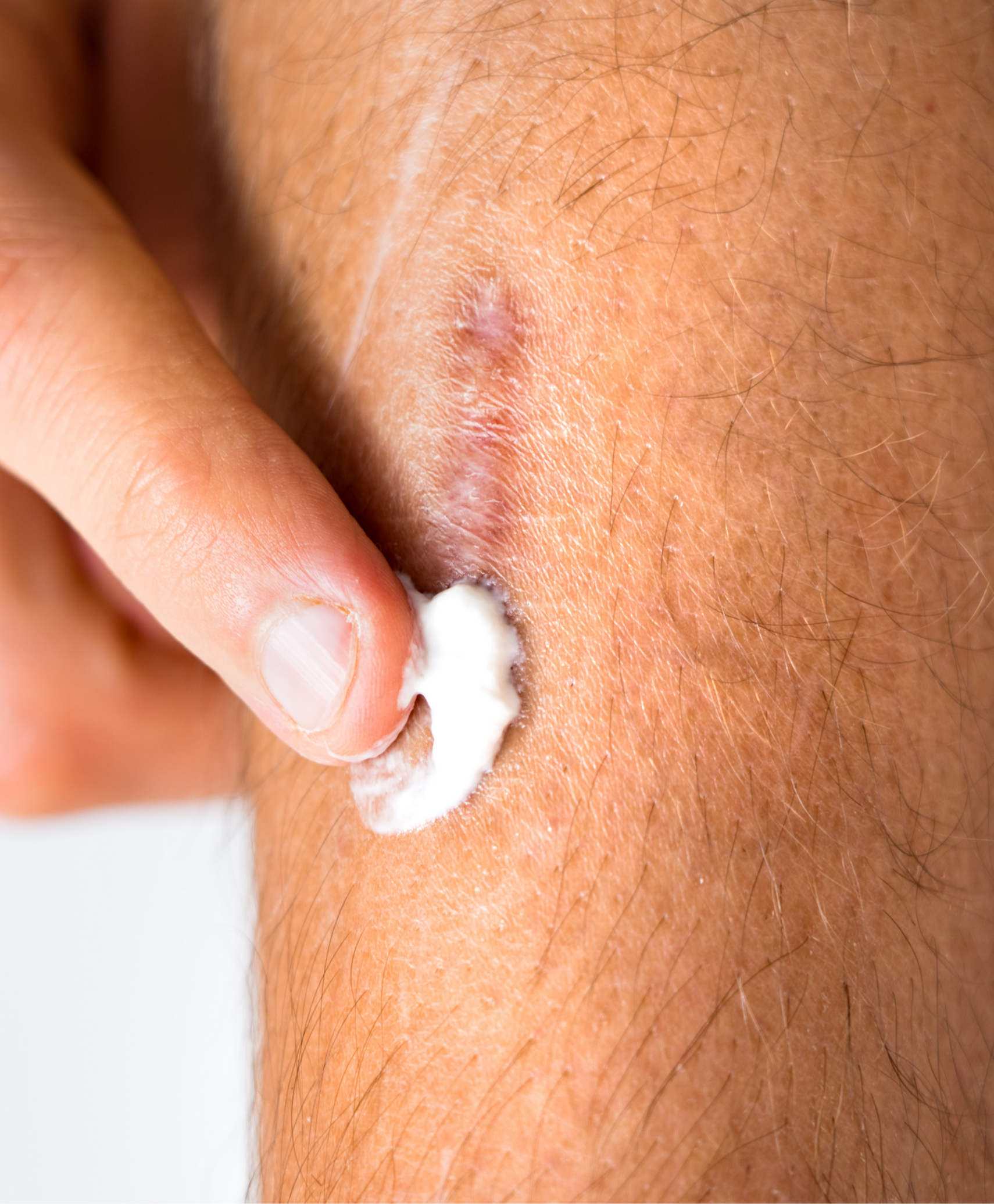 reducir cicatriz roja